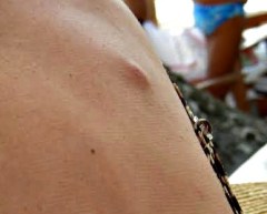 C5 Bullet stuck in my back 2 weeks after the shooting